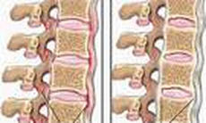 Viêm cột sống dính khớp-Bệnh của nam giới trẻ tuổi (Kỳ II)